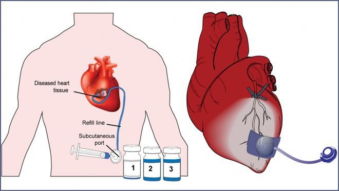 Therepi Drug Delivery